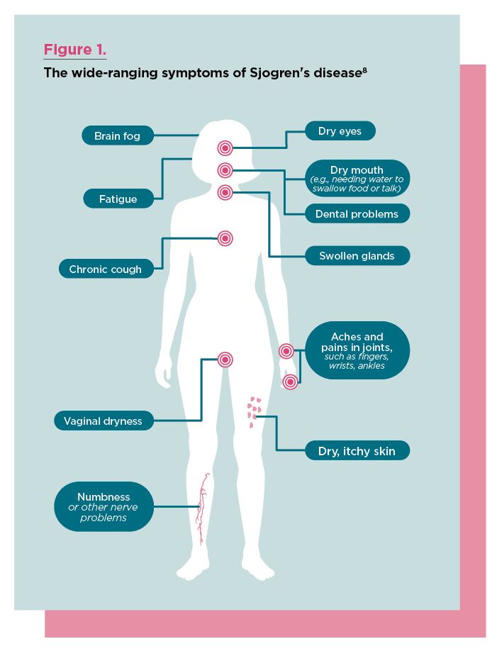 Human figure with indicators of symptoms of Sjogren's disease.